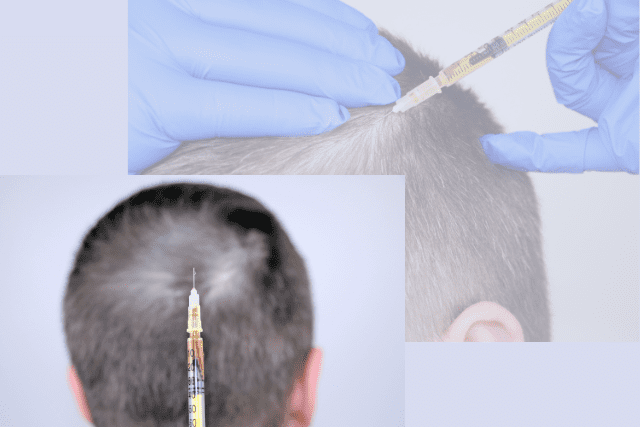 Mesotherapy hair restoration