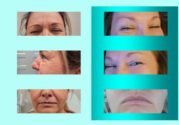 Before and after images of Botox client