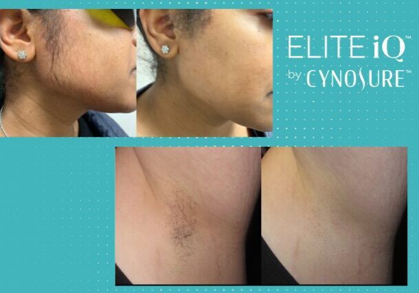 Before and after of laser hair removal treatments.