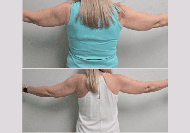Before and one week after one treatment of Lipo-Mino Mix C